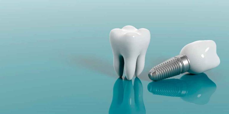 Dental Implants – Today’s Long-Term Solution of Replacing Missing Teeth